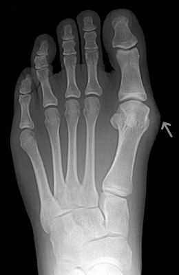 Lapidus Before Surgery - University Foot and Ankle Institute