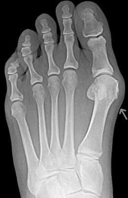 Austin Bunionectomy Before Surgery - University Foot and Ankle Institute