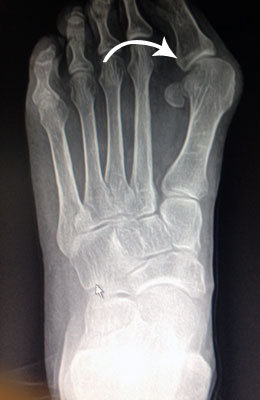 Big toe arthritis surgery before picture