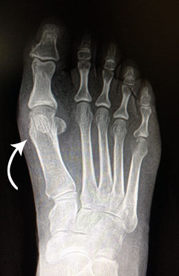 Hallux Limitus Surgery Before Pciture, University Foot and Ankle Institute