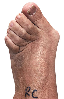 Hallux Rigidus MPJ Fusion before and after image, University Foot and Ankle Institute