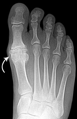 Arthrosurface Before Surgery - University Foot and Ankle Institute