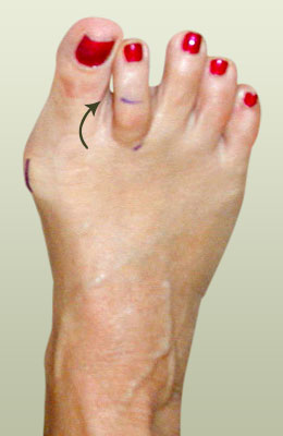 Bunion with Crossover Before Surgery - University Foot and Ankle Institute