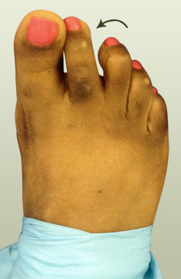 Plantar Plate Surgery Before Picture, University Foot and Ankle Institute