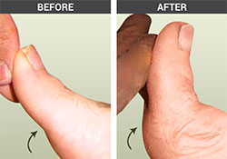 Hallux Limitus - University Foot and Ankle Institute