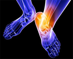 The Epidemic of Ankle Sprains and Why They Should Not Be Ignored