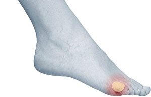 How to get rid of Corns and Callus, University Foot and Ankle Institute