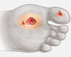 Diabetic foot ulcer