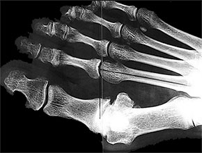Hallux Rigidus