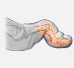 Hammertoe Representation