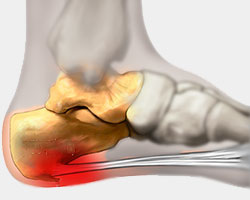 Heel pain