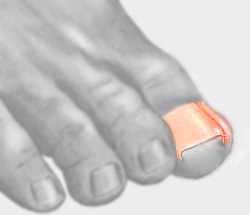 Ingrown Toenails