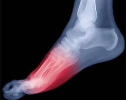 Metatarsalgia, University Foot and Ankle Institute