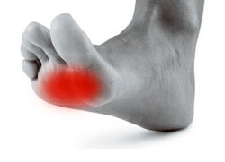 Metatarsal Conditions, UFAI