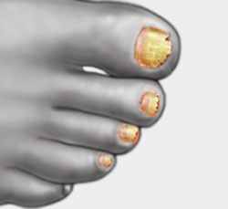 Pinpoint laser for toenail fungus