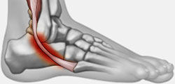 Peroneal tendon tear