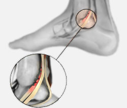 Posterior Tibial Tendon Injury