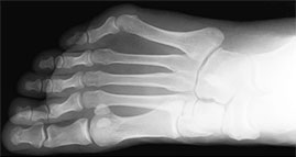 Tailors Bunion, University Foot and Ankle Institute