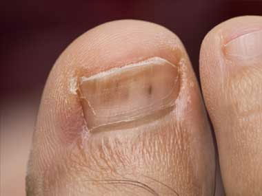 Tiny, red lines under the toenail, University Foot and Ankle Institute