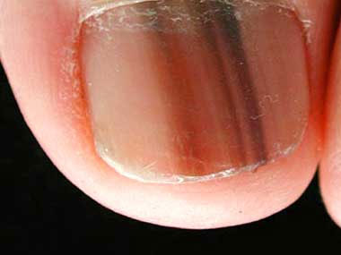 Lines on your Toenails and Cancer, University Foot and Ankle Institute