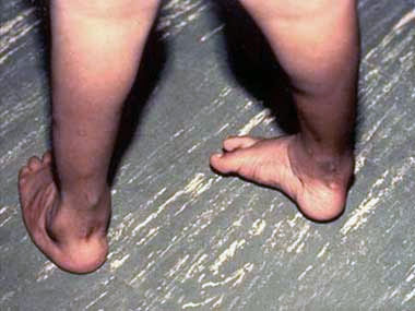 Feet Clubbing and Heart Disease, University Foot and Ankle Institute