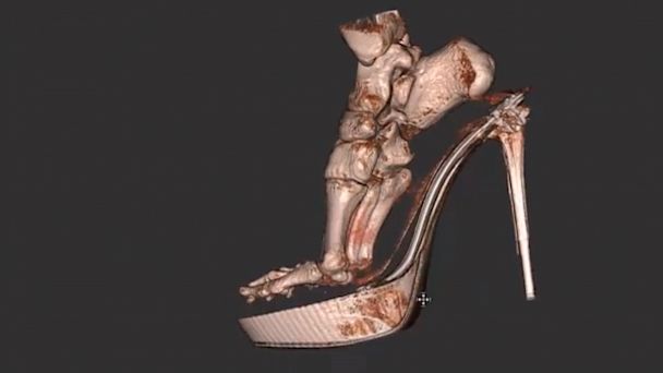 High Heel Foot Xray