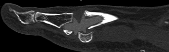 Preoperative sagittal computed tomography, Dr. Ryan Carter and University Foot and Ankle Institute